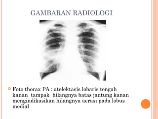 GAMBARAN RADIOLOGI
 Foto thorax PA : atelektasis lobaris tengah
kanan tampak hilangnya batas jantung kanan
mengindikasikan hilangnya aerasi pada lobus
medial
 