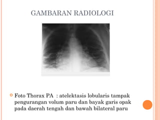 GAMBARAN RADIOLOGI
 Foto Thorax PA : atelektasis lobularis tampak
pengurangan volum paru dan bayak garis opak
pada daerah tengah dan bawah bilateral paru
 