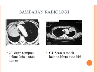 GAMBARAN RADIOLOGI
 CT Scan tampak
kolaps lobus atas
kanan
 CT Scan tampak
kolaps lobus atas kiri
 