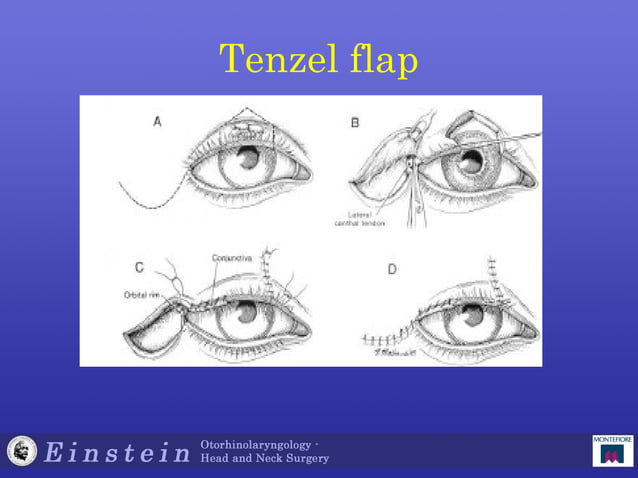 232b-coclia-97-98-eyelid-reconstruction-facial-reanimation