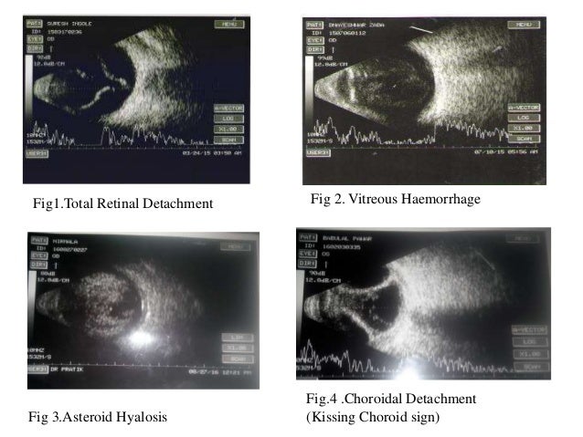 Study Of B Scan Ocular Ultrasound In Diagnosing Posterior Segment Pa Study Of B Scan Ocular Ultrasound In Diagnosing Posterior Segment Pa