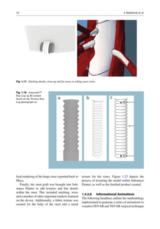 ﬁnal rendering of the lungs once exported back to
Maya.
Finally, the stent graft was brought into Sub-
stance Painter to add textures and ﬁne details
within the stent. This included stitching, wires
and a number of other important markers featured
on the device. Additionally, a fabric texture was
created for the body of the stent and a metal
texture for the wires. Figure 1.23 depicts the
process of texturing the model within Substance
Painter, as well as the ﬁnished product created.
1.3.2.8 Informational Animations
The following headlines outline the methodology
implemented to generate a series of animations to
visualise FEVAR and TEVAR surgical technique
Fig. 1.17 Stitching details: close-up and far away on rolling curve wires
Fig. 1.18 Anaconda™
Iliac Leg (a, b) created
based on the Terumo Iliac
Leg photograph (c)
16 S. Bakalchuk et al.
 