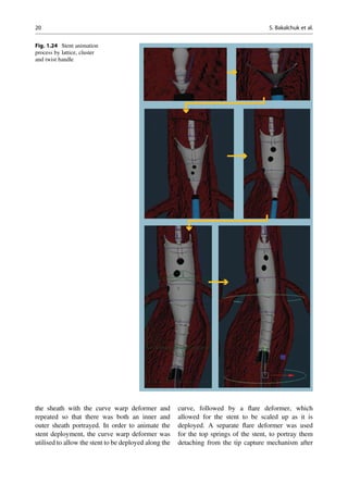 the sheath with the curve warp deformer and
repeated so that there was both an inner and
outer sheath portrayed. In order to animate the
stent deployment, the curve warp deformer was
utilised to allow the stent to be deployed along the
curve, followed by a ﬂare deformer, which
allowed for the stent to be scaled up as it is
deployed. A separate ﬂare deformer was used
for the top springs of the stent, to portray them
detaching from the tip capture mechanism after
Fig. 1.24 Stent animation
process by lattice, cluster
and twist handle
20 S. Bakalchuk et al.
 