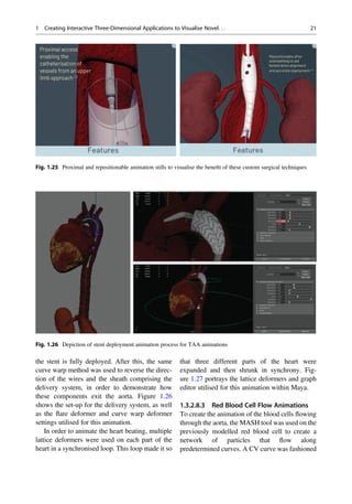the stent is fully deployed. After this, the same
curve warp method was used to reverse the direc-
tion of the wires and the sheath comprising the
delivery system, in order to demonstrate how
these components exit the aorta. Figure 1.26
shows the set-up for the delivery system, as well
as the ﬂare deformer and curve warp deformer
settings utilised for this animation.
In order to animate the heart beating, multiple
lattice deformers were used on each part of the
heart in a synchronised loop. This loop made it so
that three different parts of the heart were
expanded and then shrunk in synchrony. Fig-
ure 1.27 portrays the lattice deformers and graph
editor utilised for this animation within Maya.
1.3.2.8.3 Red Blood Cell Flow Animations
To create the animation of the blood cells ﬂowing
through the aorta, the MASH tool was used on the
previously modelled red blood cell to create a
network of particles that ﬂow along
predetermined curves. A CV curve was fashioned
Fig. 1.25 Proximal and repositionable animation stills to visualise the beneﬁt of these custom surgical techniques
Fig. 1.26 Depiction of stent deployment animation process for TAA animations
1 Creating Interactive Three-Dimensional Applications to Visualise Novel. . . 21
 
