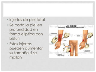 • Injertos de piel total
• Se corta la piel en
profundidad en
forma elíptica con
bisturí
• Estos injertos
pueden aumentar
su tamaño si se
mallan
 