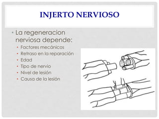 INJERTO NERVIOSO
• La regeneracion
nerviosa depende:
• Factores mecánicos
• Retraso en la reparación
• Edad
• Tipo de nervio
• Nivel de lesión
• Causa de la lesión
 