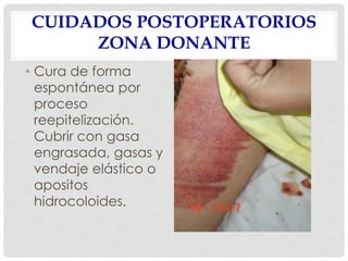 CUIDADOS POSTOPERATORIOS
ZONA DONANTE
• Cura de forma
espontánea por
proceso
reepitelización.
Cubrir con gasa
engrasada, gasas y
vendaje elástico o
apositos
hidrocoloides.
 