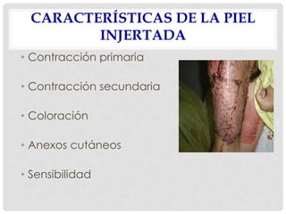 CARACTERÍSTICAS DE LA PIEL
INJERTADA
• Contracción primaria
• Contracción secundaria
• Coloración
• Anexos cutáneos
• Sensibilidad
 