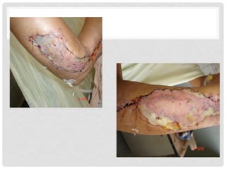 234410572-INJERTOS-ppt.pdf