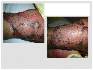 234410572-INJERTOS-ppt.pdf