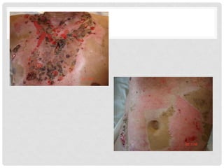 234410572-INJERTOS-ppt.pdf