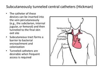 Image Hickman Process Total parenteral nutrition | PPTX