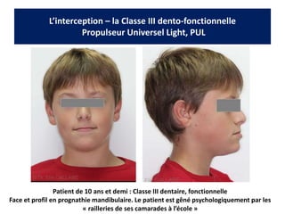 L’interception – la Classe III dento-fonctionnelle
Propulseur Universel Light, PUL
Patient de 10 ans et demi : Classe III dentaire, fonctionnelle
Face et profil en prognathie mandibulaire. Le patient est gêné psychologiquement par les
« railleries de ses camarades à l’école »
 