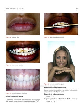 Revista ADM 2007;LXIV(3):97-109 105
edigraphic.com
Inclinación del plano oclusal
Observamos la inclinación de nuestro plano oclusal, ya que
éste no debe variar durante el tratamiento (Figura 21).14
Asimetrías faciales y laterognasias
Observamos si existen asimetrías faciales en los maxila-
res y su desviación (Figura 22).15
Obtención de imágenes iniciales
Figuras 23 a 31
Imágenes posteriores al tratamiento (3 años después)
Figuras 32 a 40
Figura 18. Tonicidad labial.
Figura 19. Líneas medias dentales.
Figura 20. Mordida cruzada o telescópica.
Figura 21. Inclinación del plano oclusal.
Figura 22. Asimetría facial y laterognasia.
 