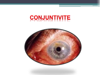 CONJUNTIVITE
 