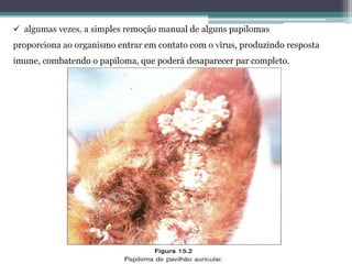  algumas vezes, a simples remoção manual de alguns papilomas
proporciona ao organismo entrar em contato com o vírus, produzindo resposta
imune, combatendo o papiloma, que poderá desaparecer par completo.
 