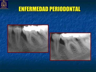 ENFERMEDAD PERIODONTAL
 