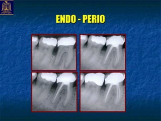 ENDO - PERIO
 