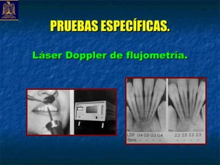 PRUEBAS ESPECÍFICAS.

Láser Doppler de flujometría.
 