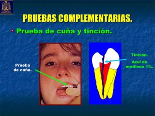 PRUEBAS COMPLEMENTARIAS.
 Prueba de cuña y tinción.


                               Tinción.
                               Azul de
 Prueba                      metileno 1%.
de cuña.
 