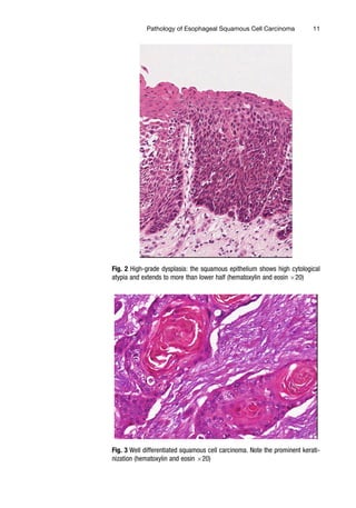 Esophageal Squamous Cell Carcinoma Methods And Protocols 1st Alfred K ...