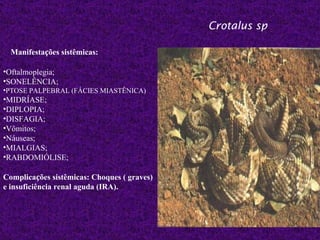 Crotalus sp

  Manifestações sistêmicas:

•Oftalmoplegia;
•SONELÊNCIA;
•PTOSE PALPEBRAL (FÁCIES MIASTÊNICA)
•MIDRÍASE;
•DIPLOPIA;
•DISFAGIA;
•Vômitos;
•Náuseas;
•MIALGIAS;
•RABDOMIÓLISE;

Complicações sistêmicas: Choques ( graves)
e insuficiência renal aguda (IRA).
 