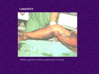 Laquético




Edema, equimose, necrose cutânea (foto: J.S. Haad)
 