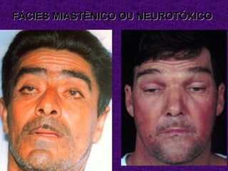 FÁCIES MIASTÊNICO OU NEUROTÓXICO
 