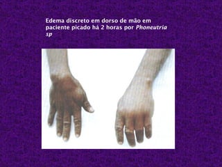 Edema discreto em dorso de mão em
paciente picado há 2 horas por Phoneutria
sp
 
