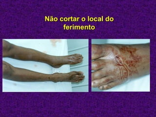 Não cortar o local do
     ferimento
 