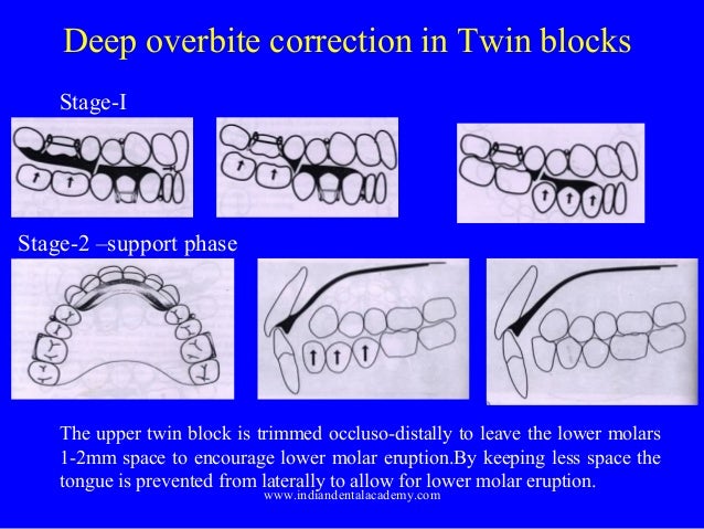overbite orthodontic