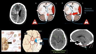 HERNIACION CEREBRAL EXPOSICION.......... | PPTX