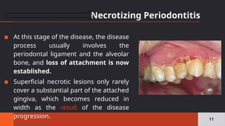 Necrotizing Periodontitis
11
▪ At this stage of the disease, the disease
process usually involves the
periodontal ligament and the alveolar
bone, and loss of attachment is now
established.
▪ Superficial necrotic lesions only rarely
cover a substantial part of the attached
gingiva, which becomes reduced in
width as the result of the disease
progression.
 