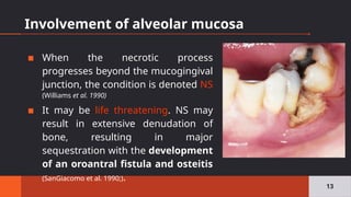 Involvement of alveolar mucosa
▪ When the necrotic process
progresses beyond the mucogingival
junction, the condition is denoted NS
(Williams et al. 1990)
▪ It may be life threatening. NS may
result in extensive denudation of
bone, resulting in major
sequestration with the development
of an oroantral fistula and osteitis
(SanGiacomo et al. 1990;).
13
 