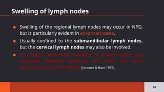 Swelling of lymph nodes
▪ Swelling of the regional lymph nodes may occur in NPD,
but is particularly evident in advanced cases.
▪ Usually confined to the submandibular lymph nodes,
but the cervical lymph nodes may also be involved.
▪ In children with NPD, swelling of lymph nodes and
increased bleeding tendency are often the most
pronounced clinical findings (Jimenez & Baer 1975).
14
 