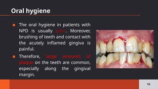 Oral hygiene
▪ The oral hygiene in patients with
NPD is usually poor. Moreover,
brushing of teeth and contact with
the acutely inflamed gingiva is
painful.
▪ Therefore, large amounts of
plaque on the teeth are common,
especially along the gingival
margin.
16
 