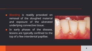 ▪ Bleeding is readily provoked on
removal of the sloughed material
and exposure of the ulcerated
underlying connective tissue.
▪ In early phases of the disease,
lesions are typically confined to the
top of a few interdental papillae.
8
 