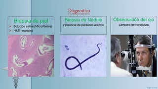 Diagnostico
Biopsia de piel
 Solución salina (Microfilarias)
 H&E (espécie)
Biopsia de Nódulo
Presencia de parásitos adultos
Observación del ojo
Lámpara de hendidura
 