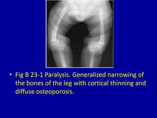 23 overconstriction or overtubulation (narrow diametaphysis) | PPTX