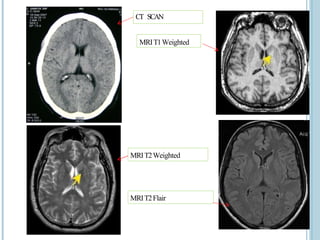CT SCAN
MRIT1Weighted
MRIT2Weighted
MRIT2Flair
 
