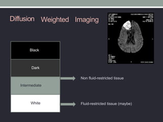 Diffusion Weighted Imaging
Non fluid-restricted tissue
Fluid-restricted tissue (maybe)
Black
Dark
Intermediate
White
 