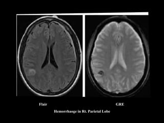 Flair GRE
Hemorrhaoge in Rt. Parietal Lobe
 