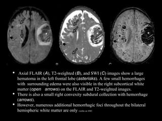 • Axial FLAIR (A), T2-weighted (B), and SWI (C) images show a large
hematoma in the left frontal lobe (asterisks). A few small hemorrhages
with surrounding edema were also visible in the right subcortical white
matter (open arrows) on the FLAIR and T2-weighted images.
• There is also a small right convexity subdural collection with hemorrhage
(arrows).
• However, numerous additional hemorrhagic foci throughout the bilateral
hemispheric white matter are only visible on SWI
 