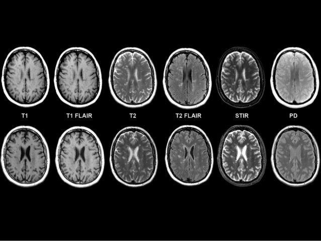 MRI basics - How to read and understand MRI sequences