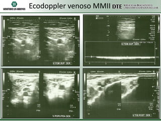 Ecodoppler venoso MMII

 