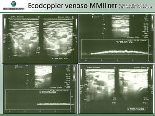 Ecodoppler venoso MMII

 