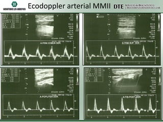 Ecodoppler arterial MMII

 