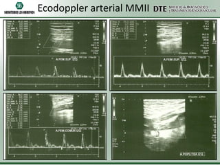 Ecodoppler arterial MMII

 