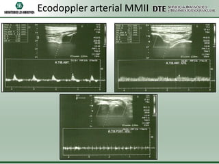 Ecodoppler arterial MMII

 