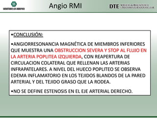 Angio RMI

•CONCLUSIÓN:
•ANGIORRESONANCIA MAGNÉTICA DE MIEMBROS INFERIORES
QUE MUESTRA UNA OBSTRUCCION SEVERA Y STOP AL FLUJO EN
LA ARTERIA POPLITEA IZQUIERDA, CON REAPERTURA DE
CIRCULACION COLATERAL QUE RELLENAN LAS ARTERIAS
INFRAPATELARES. A NIVEL DEL HUECO POPLITEO SE OBSERVA
EDEMA INFLAMATORIO EN LOS TEJIDOS BLANDOS DE LA PARED
ARTERIAL Y DEL TEJIDO GRASO QUE LA RODEA.
•NO SE DEFINE ESTENOSIS EN EL EJE ARTERIAL DERECHO.

 